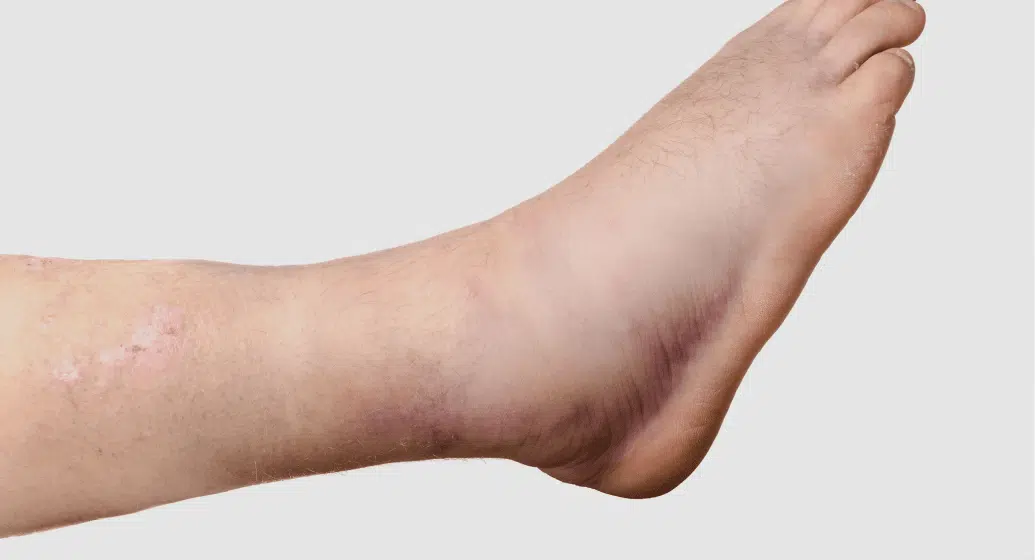 Swollen Foot / Ankle
