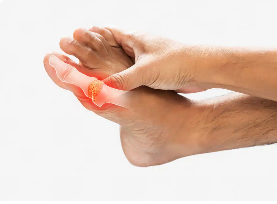 Arthritis Can Cause Pain in the Feet and Ankles