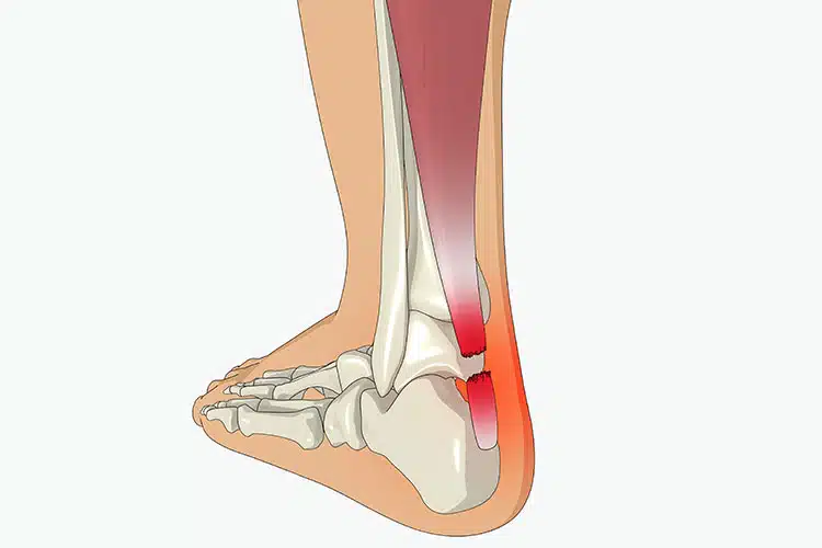 Achilles Tendon Injuries