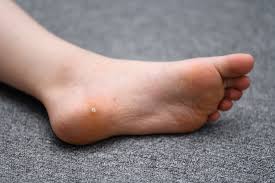 All About Plantar Warts