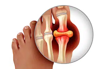 Dangers of Chronic Tophaceous Gout