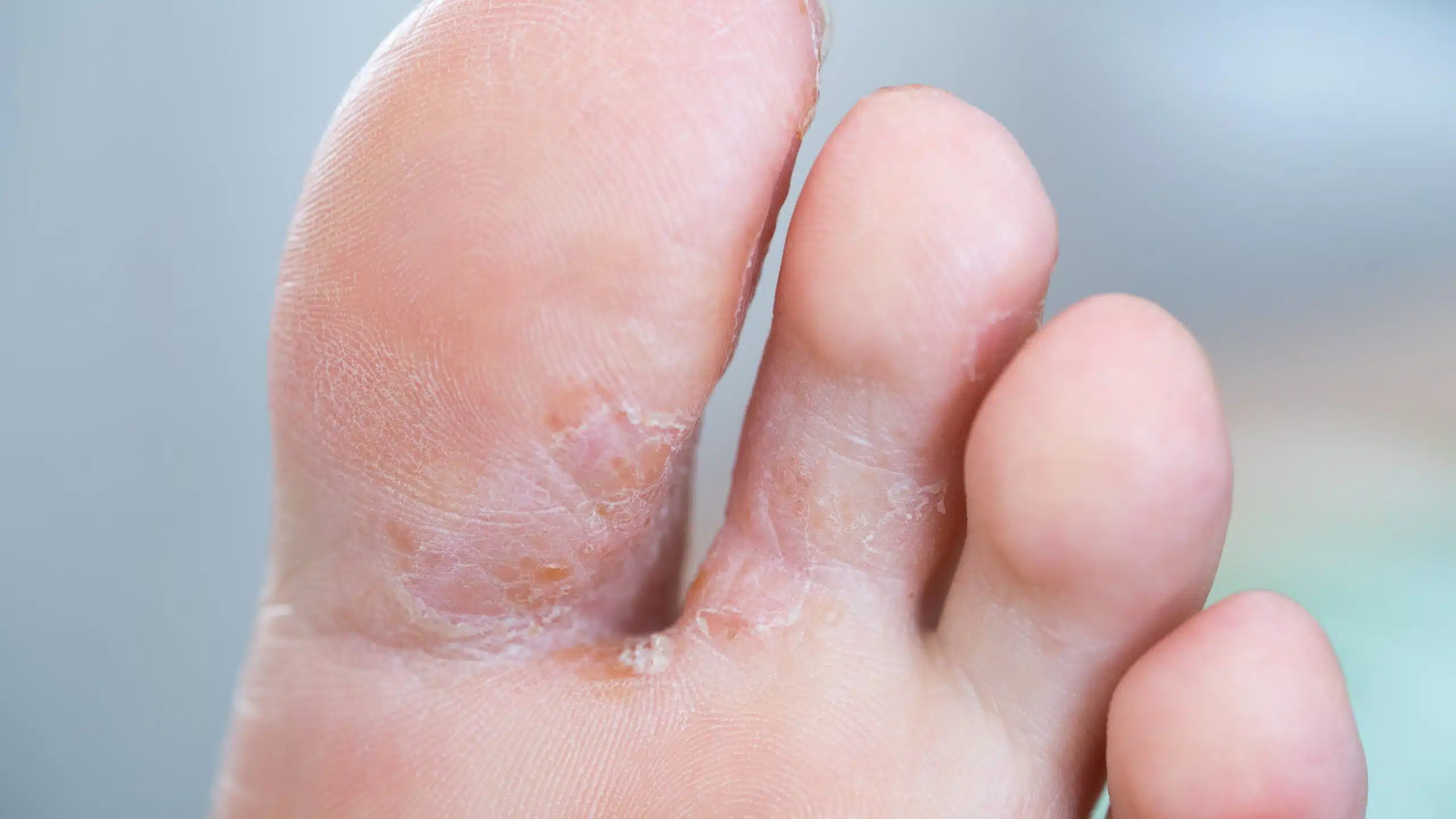 How to Deal with Athlete’s Foot