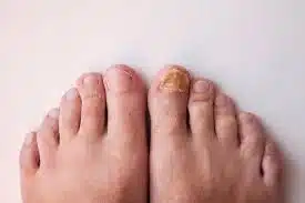 How to Treat Your Toenail Fungus