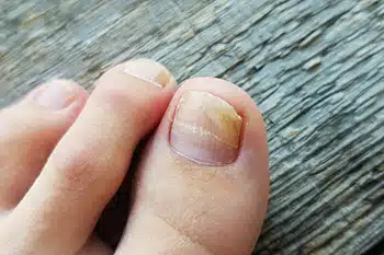 Hygienic Ways to Limit Toenail Fungus