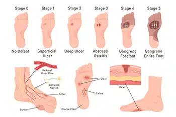 Sedentary Lifestyle and Diabetic Foot Ulcers