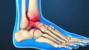 Sports Related Foot And Ankle Injuries - At North Texas Podiatry Associates