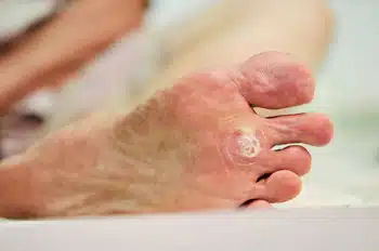 Treatment Options for Plantar Warts
