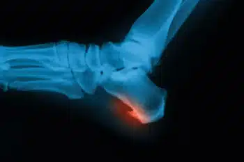 Types of Heel Spurs and Their Causes
