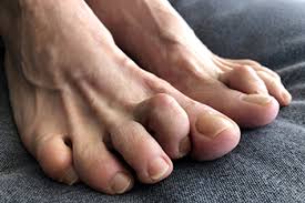 What Are Hammertoes?
