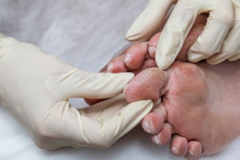 What to Know About the Diabetic Foot - At North Texas Podiatry Associates